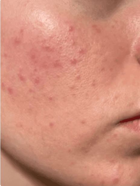 Illustrative patient skin progress at Day 1