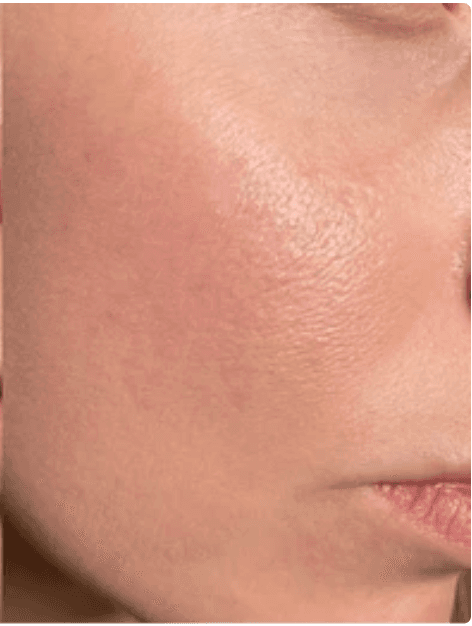 Illustrative patient skin progress at Week 4