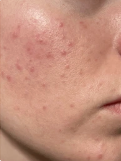 Patient skin progress: Day 1
