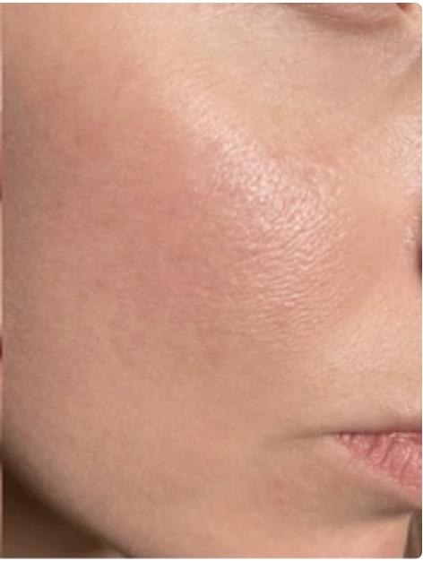 Patient skin progress: Week 4