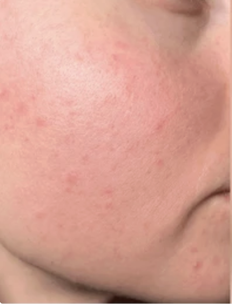 Patient skin progress: Week 2
